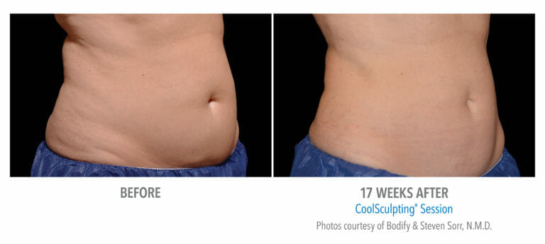 before after women belly