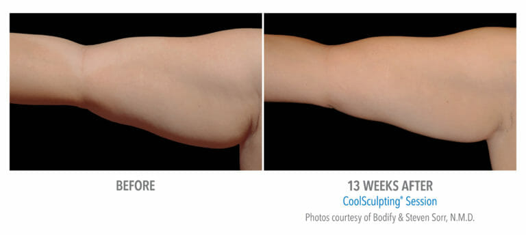 before-after arms