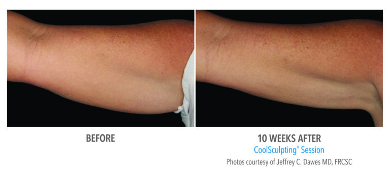 coolsculpting before after arms