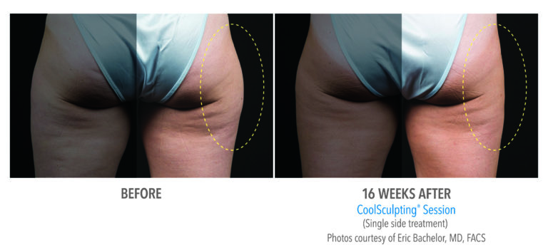coolsculpting before after outer legs