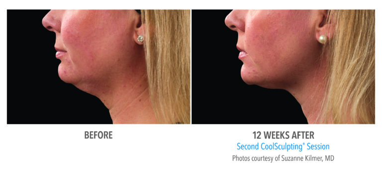 coolsculpting before after chin side view