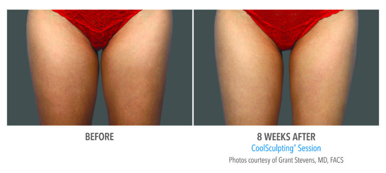 coolsculpting before after inner thighs