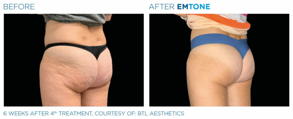 emtone-before-after-butt2
